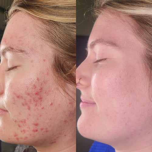 Acne bootcamp before and after: red, inflamed cheek acne fades to smooth, even skin
