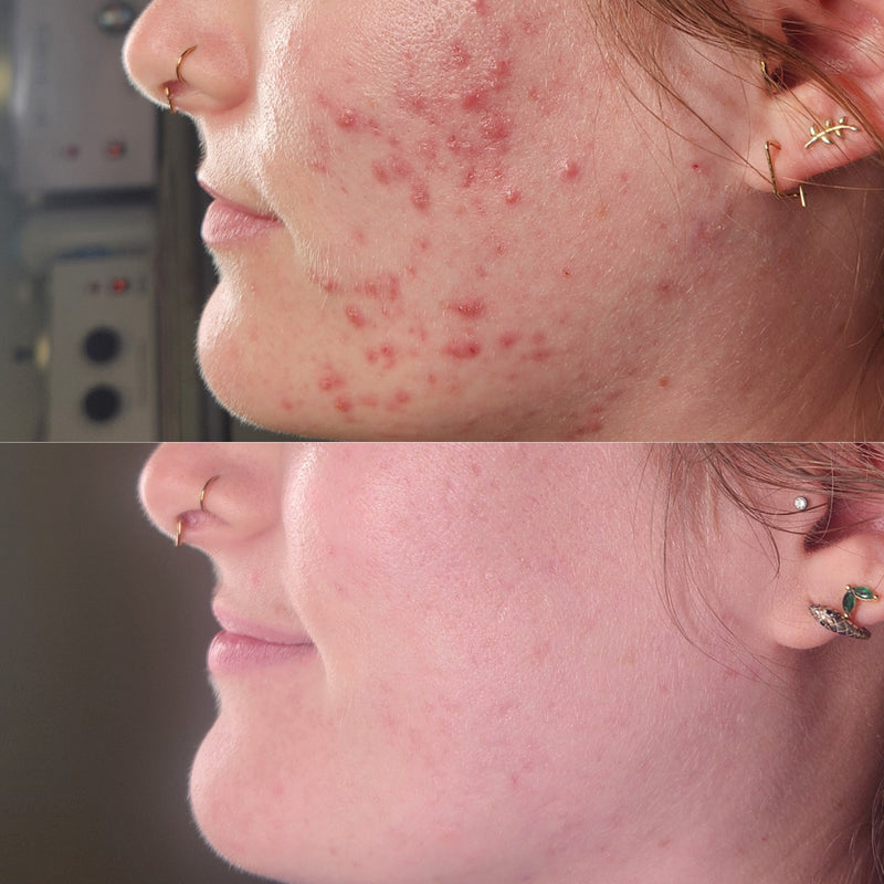 Acne bootcamp before and after: inflamed cystic acne along the cheek and jaw clears completely