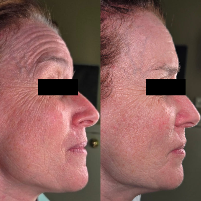 Before and after: deep lines and crepey texture on the cheek look visibly smoother