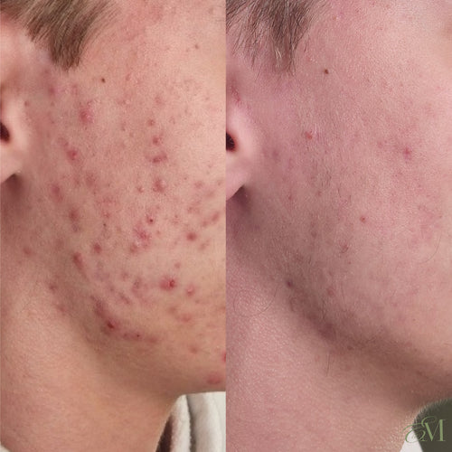 Acne bootcamp before and after: inflamed cystic acne along the cheek and jaw clears completely