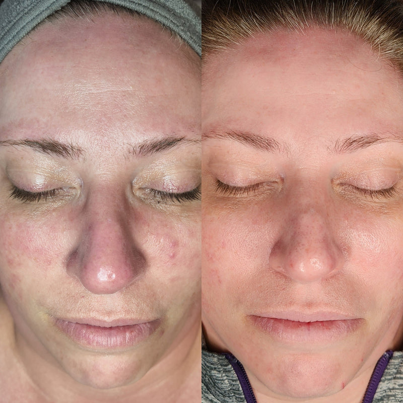 Before and after: facial redness and uneven texture calm to smoother, clearer skin