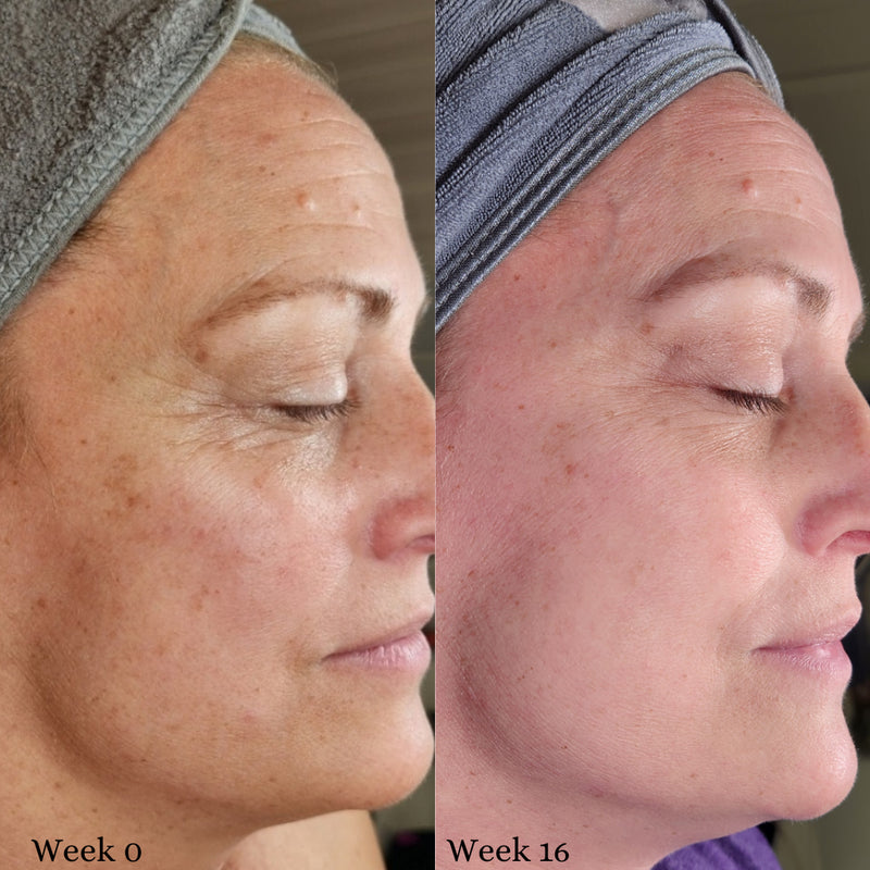 Week 0 to week 16 skin results: cheek texture and fine lines look plumper and more even