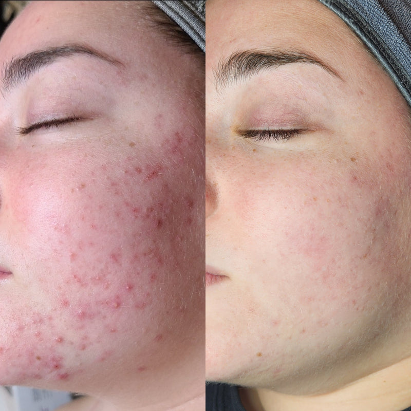 Acne bootcamp before and after: widespread red acne across the cheek calms to clear skin
