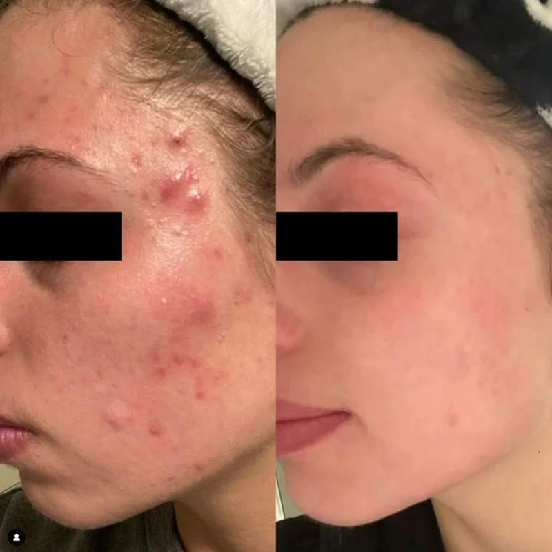 Virtual skin consult before and after: cheek acne clears over a 16-week program