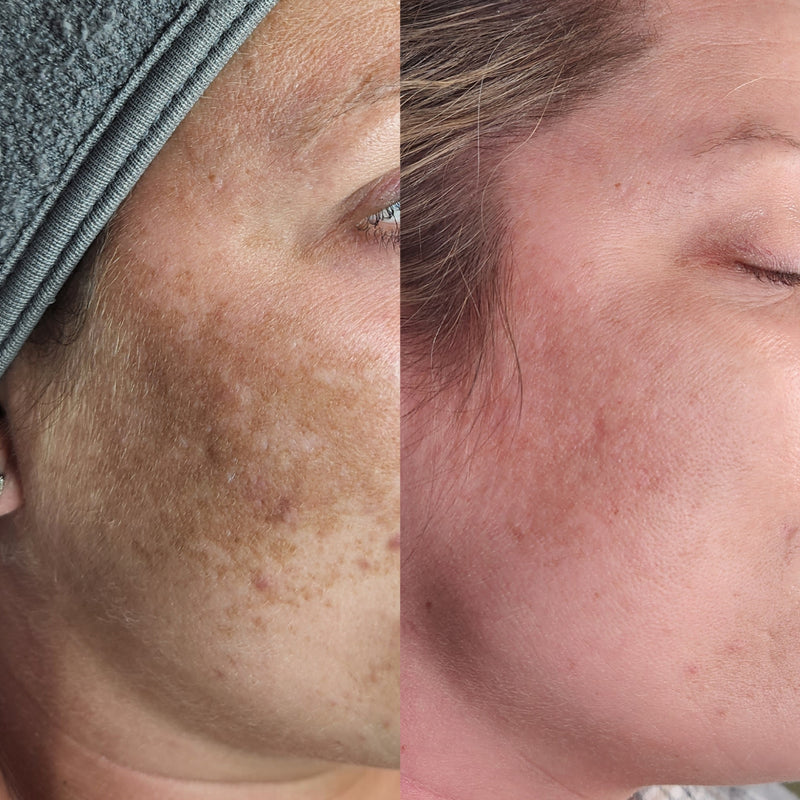 Before and after: dark hyperpigmentation patches across the cheek lighten and even out