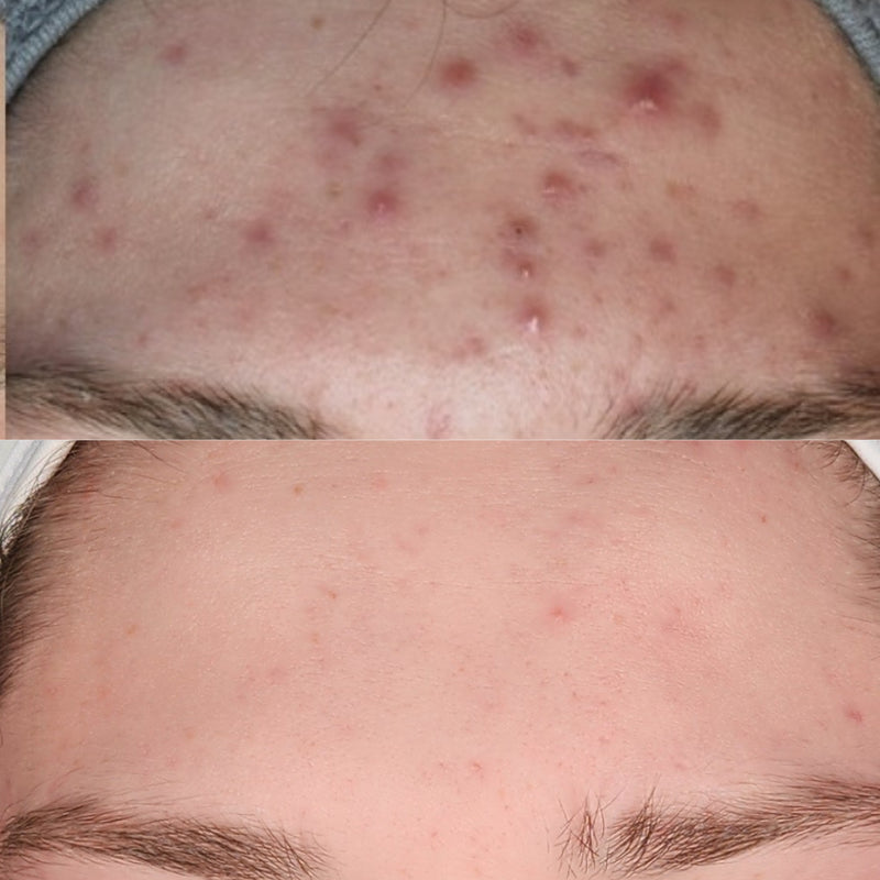 Acne bootcamp before and after: red acne bumps across the forehead clear up
