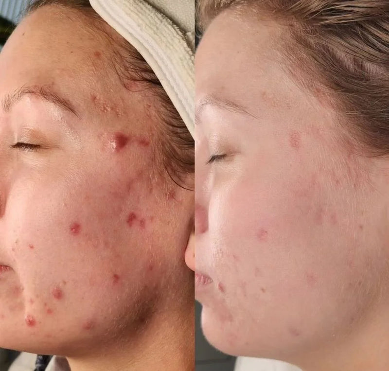 Before and after acne results: raised red breakouts along the cheek settle and clear