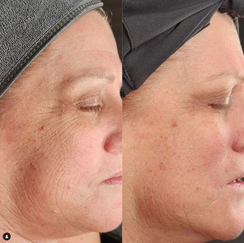 Facial before and after: fine lines and sun damage on the cheek look smoother and more even