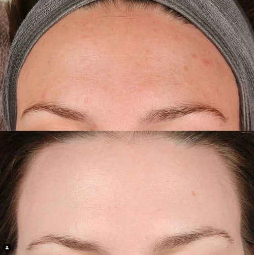 Acne bootcamp before and after: congested, bumpy forehead skin becomes smooth and clear