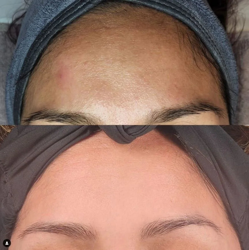 Acne bootcamp before and after: bumpy forehead breakouts clear to smooth skin