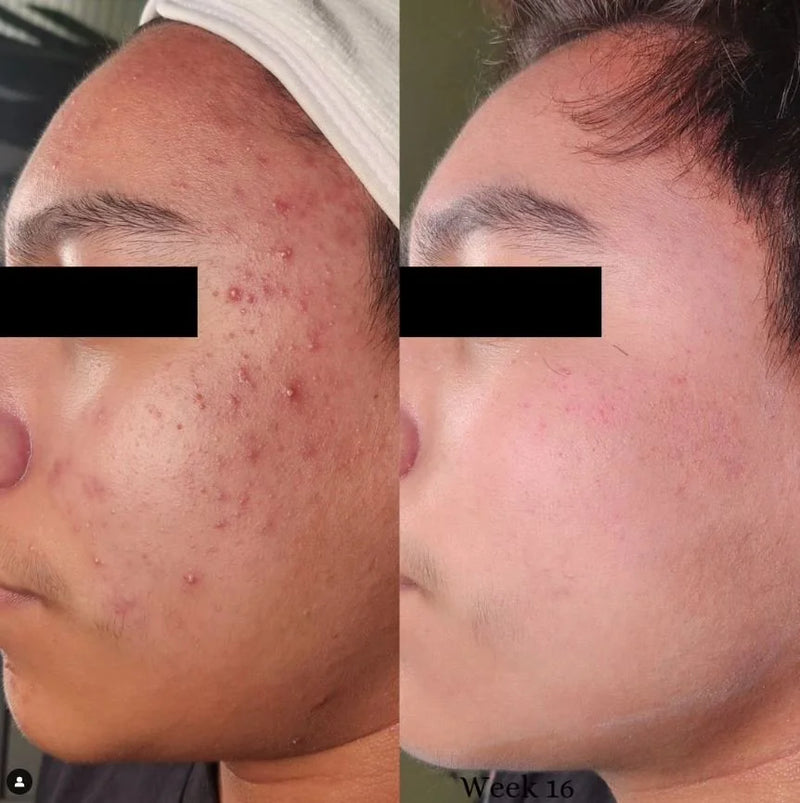 Acne bootcamp before and after at week 16: inflamed acne across the cheek clears noticeably